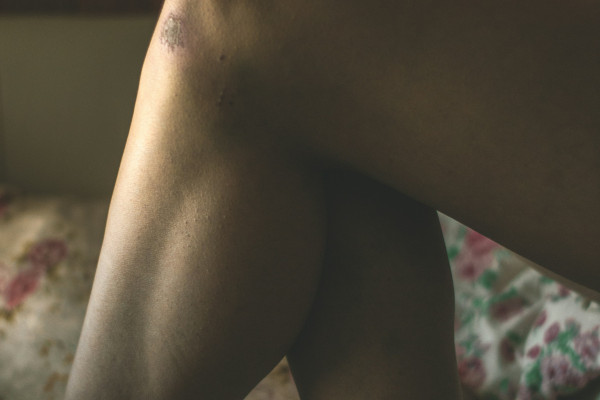 Person sitting on a bed holding their knee in discomfort, illustrating chronic knee pain