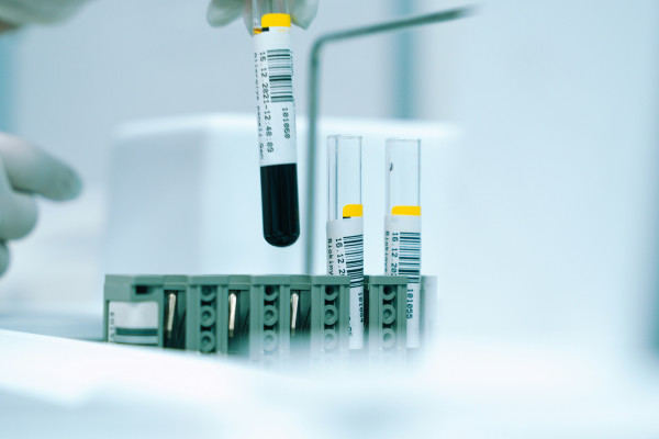 A gloved hand holding a test tube filled with liquid, representing a laboratory health test.