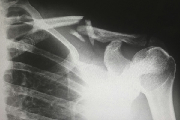An x-ray image displayed on a lightbox in a clinic, illustrating how imaging is used to assess bone and joint health