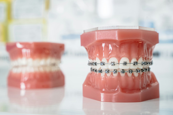 A close-up of a tooth with dental braces attached.