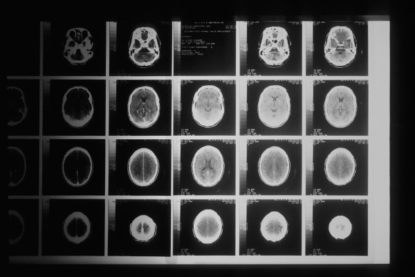 A series of black-and-white MRI scan images displayed together.